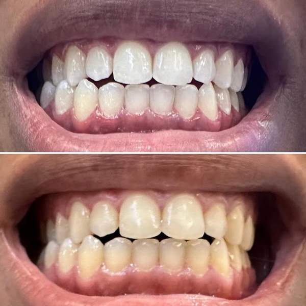 Before and after teeth whitening - real client results