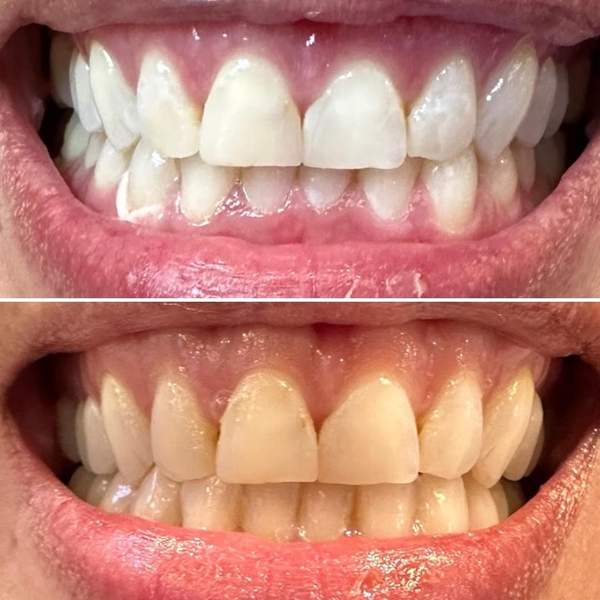 Before and after teeth whitening - real client results
