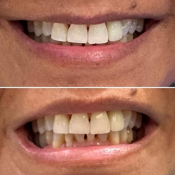 Before and after teeth whitening - real client results