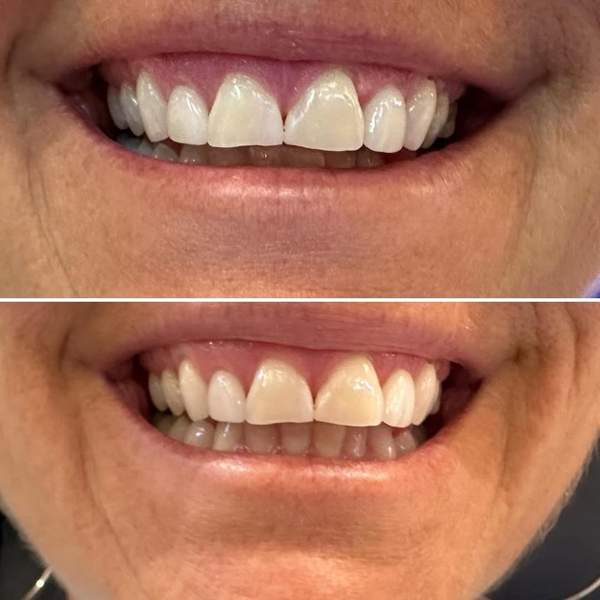 Before and after teeth whitening - real client results